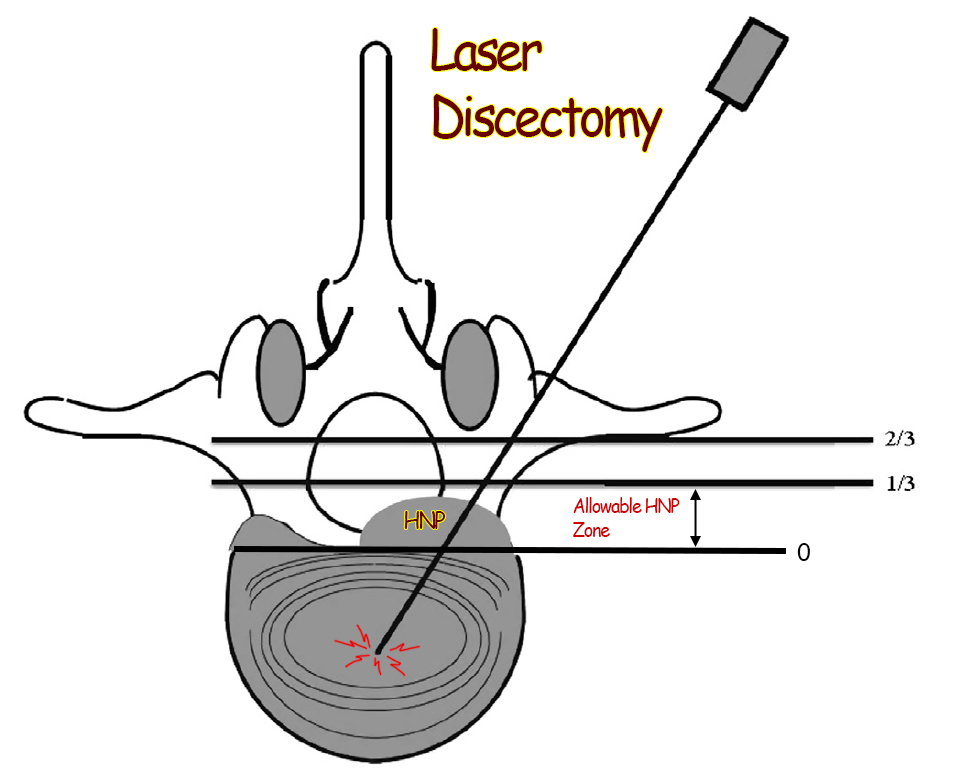 Laser discectomy